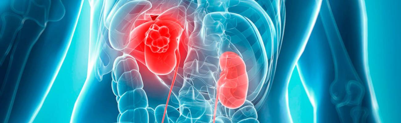Best Kidney Cancer Treatment in Baner, Pune
