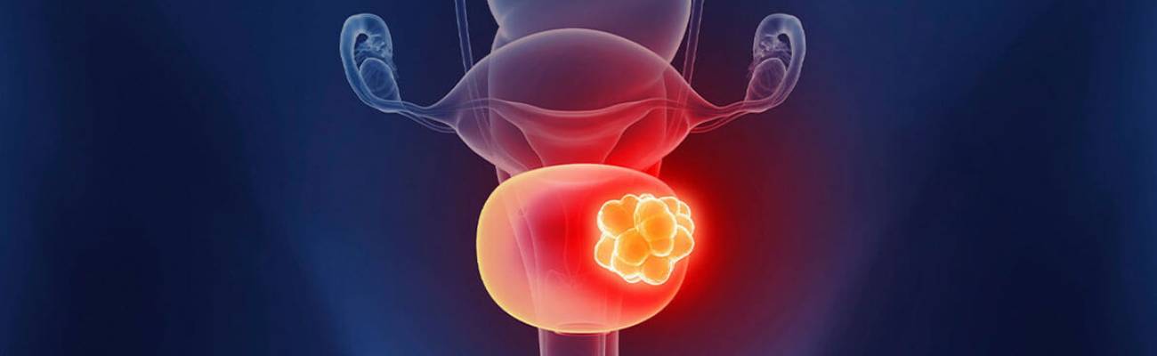 Best Bladder Cancer Treatment in Baner Pune