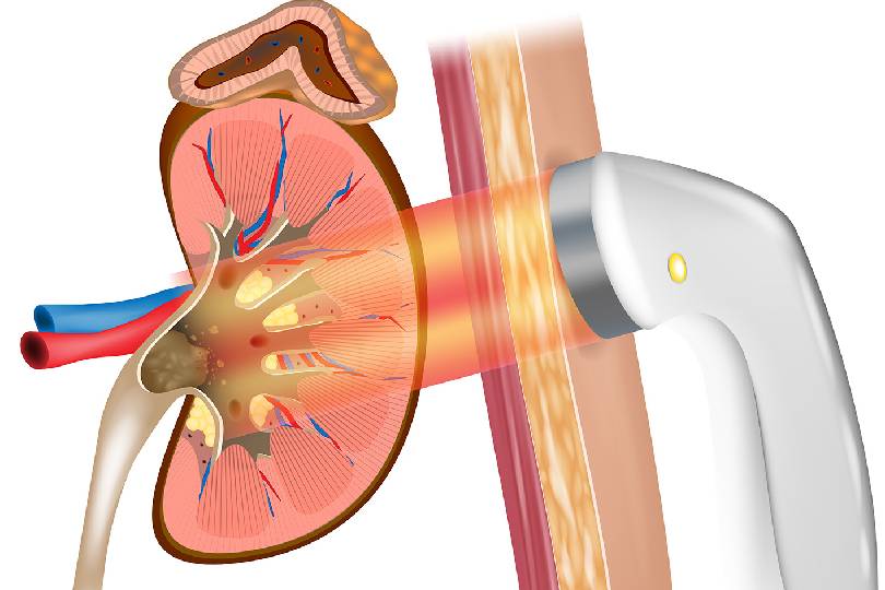 Best ESWL Surgery for Kidney Stone Removal in Baner, Pune