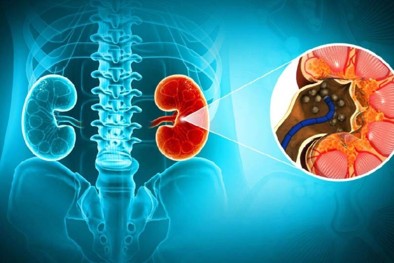 Best Kidney Stone Specialist in Baner, Pune