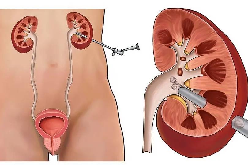 Best PCNL Surgery for Kidney Stone Removal in Baner Pune