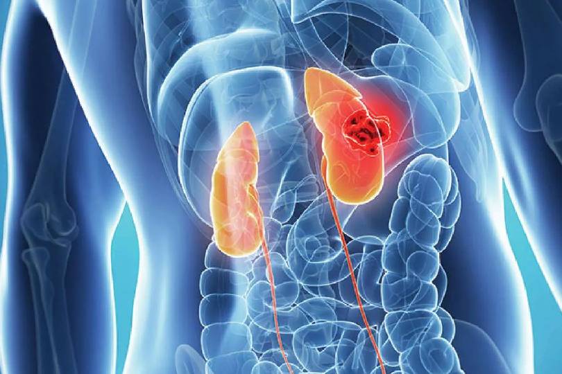 Best Kidney Cancer Treatment in Baner, Pune
