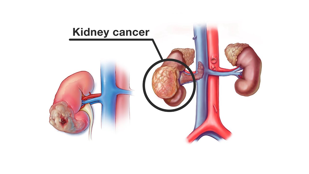 Best Kidney cancer specialist in Pune