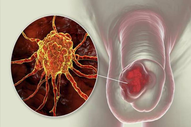 Best Penile Cancer Specialist in Baner, Pune
