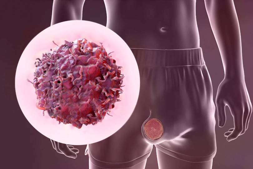 Testicular Cancer Treatment in Baner Pune