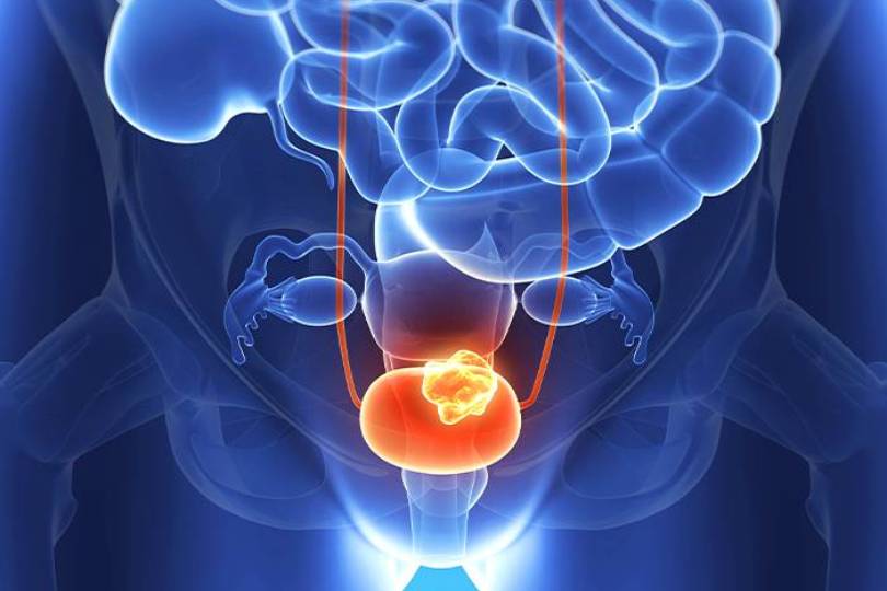 Best Urinary Bladder Cancer Treatment in Baner Pune